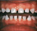 toothdecay1
