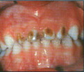 toothdecay2