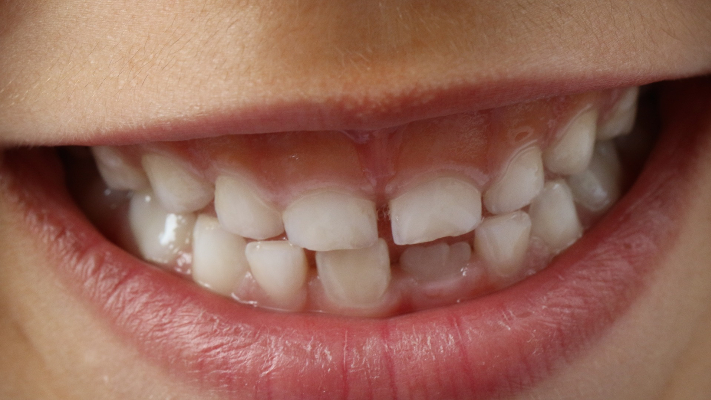 3 Dental Problems To Be on the Look-Out for in Your Child